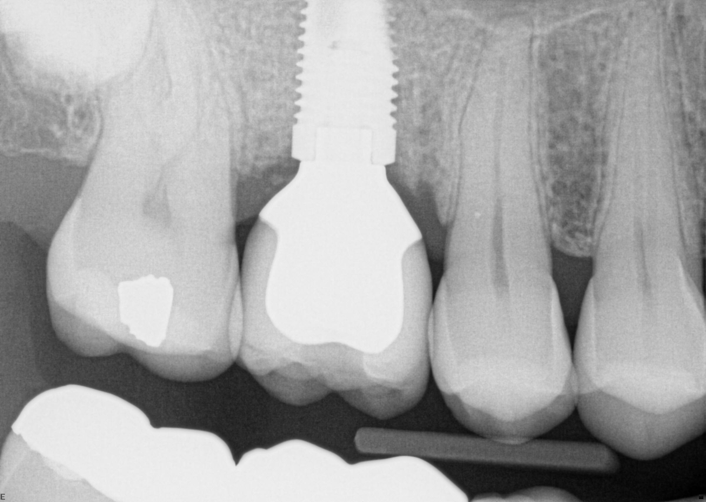 Radiograph of final crown in place